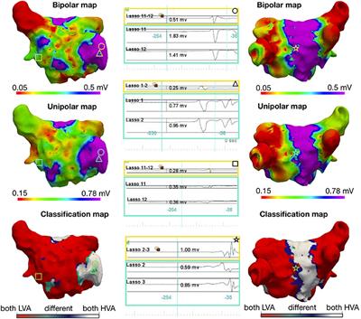 Comparison of Unipolar and Bipolar Voltage Mapping for Localization of Left Atrial Arrhythmogenic Substrate in Patients With Atrial Fibrillation